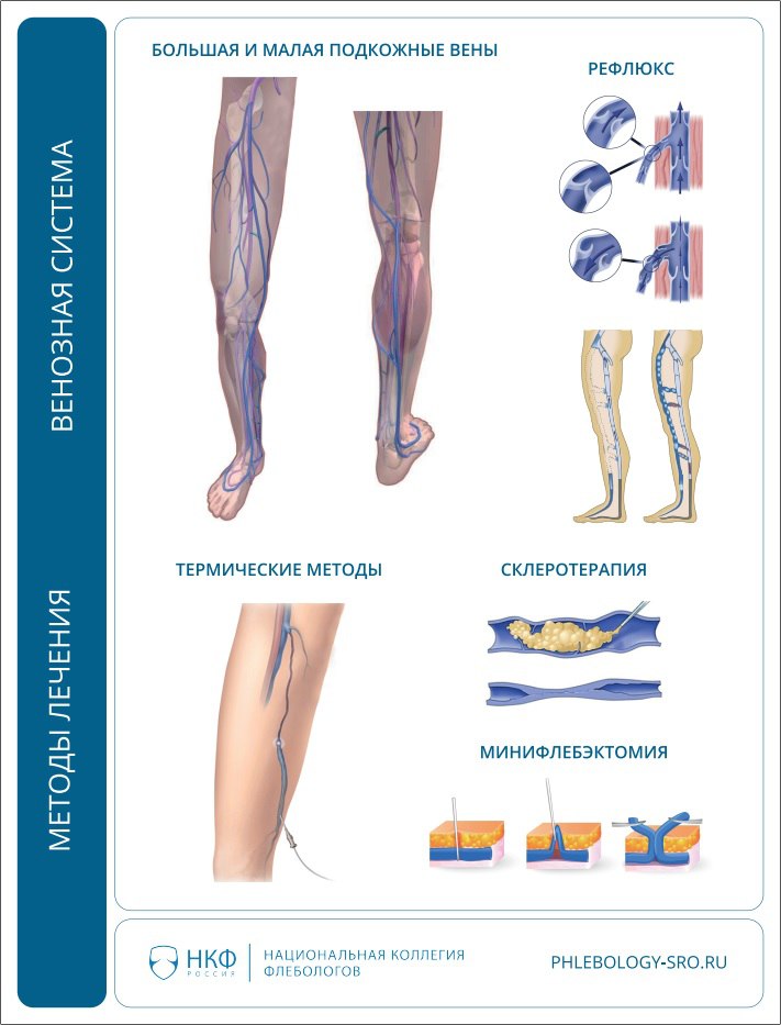 Что такое COVID-19-ассоциированная флебопатия?